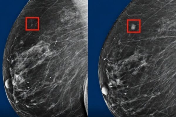 New AI Detects Breast Cancer up to 5 Years Before it Develops